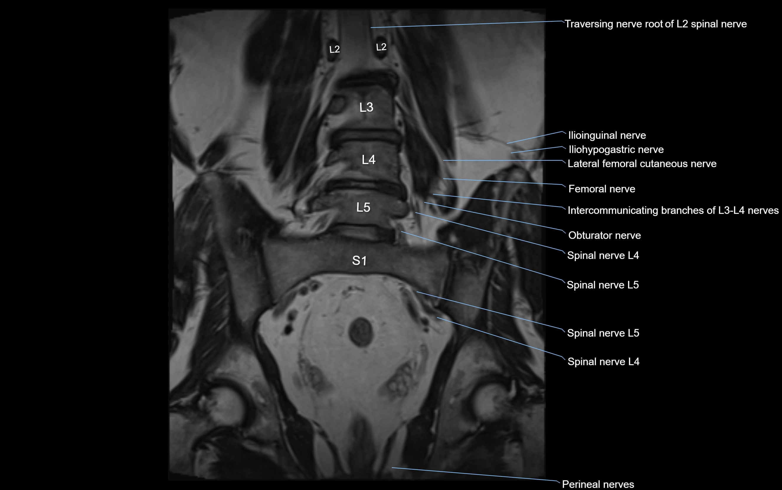 MR lumbosacral plexus cross sectional anatomy 3T  radiology  image-img-09001-00036.webp